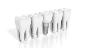 Advantages of A Dental Implant